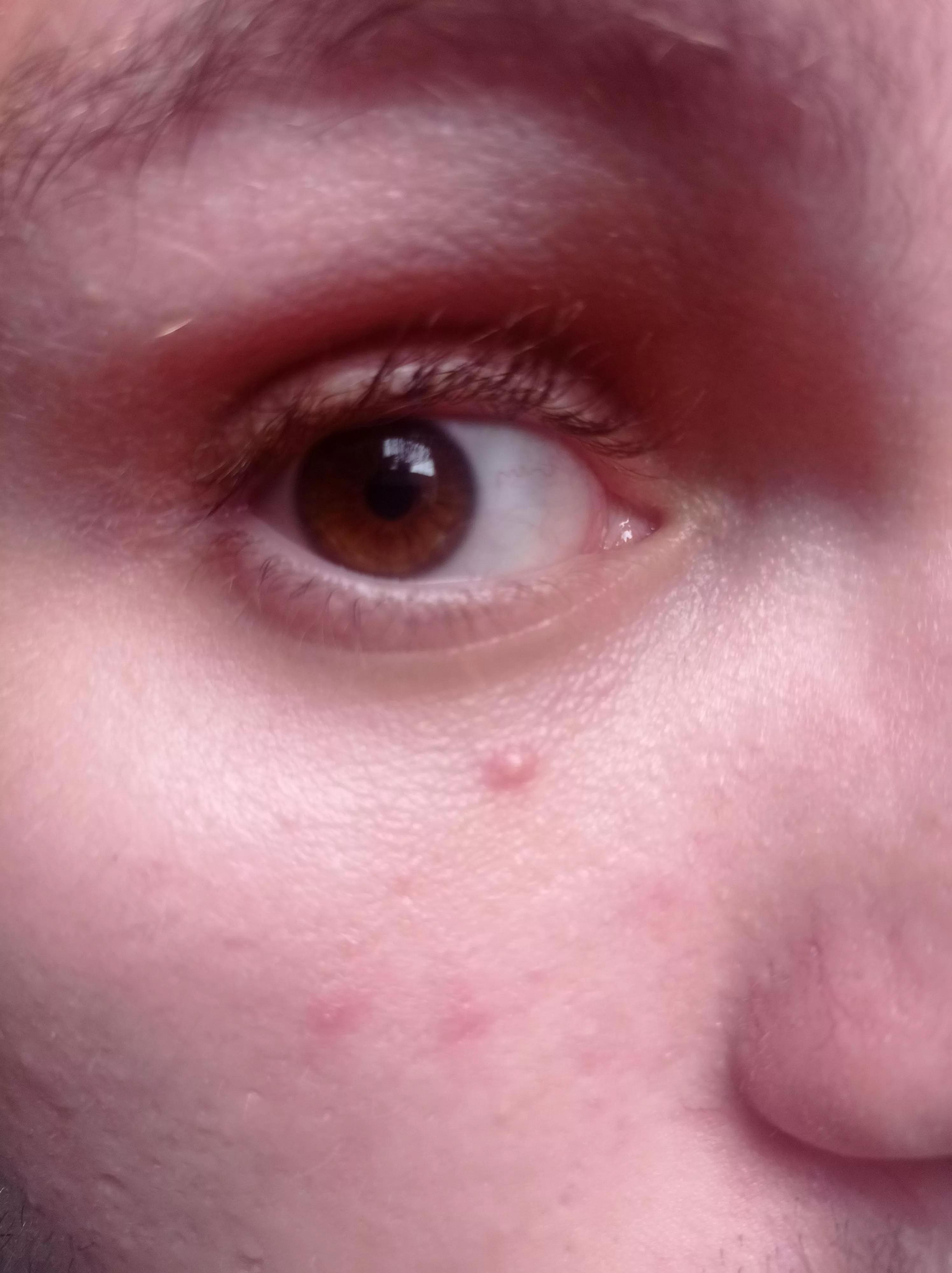 This little guy appeared on my face yesterday. Should I try to burst it with a needle? It seems like a little milia posted by Pedrao_zao