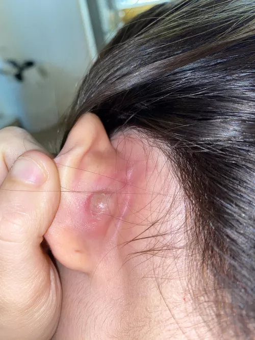 This mf hurts so bad but I wanna pop it😭😂 I don’t even know wtf it is I’m thinking a boil 🤷🏻‍♀️but when tf does it go away ahha by Middle-Tonight-277