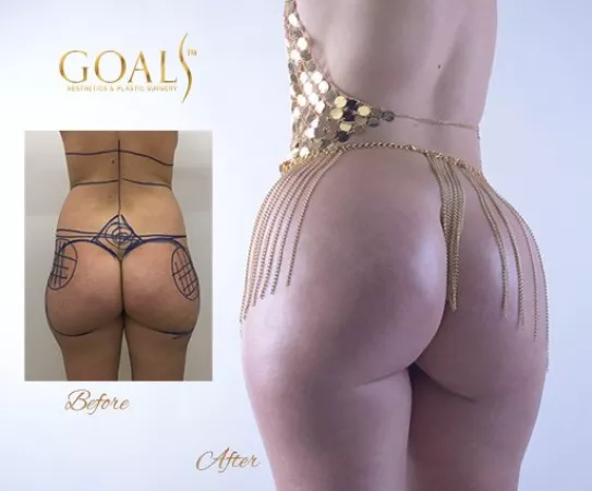 This plastic surgery clinic has the best photography for their before and after BBL photos! by twilightbreakin