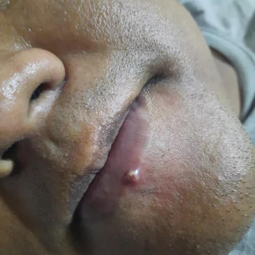 This unit of a pimple on my partner's lip. Apparently it hurts like hell. by VadMayores