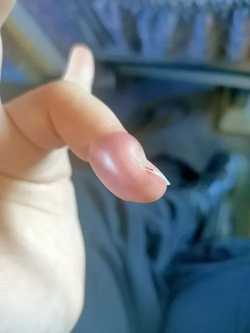 This weird thing on my finger. It's excruciating, and seems to be getting worse. Headed to the GP today, but figured you guys would find it interesting. by MrNissanCube