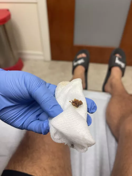 Thought I had swimmers ear, turns out… by djminze