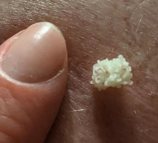 Thought y'all would enjoy this beautiful coral cloud that came out of a neverending blackhead on my bf's back (it refills every few months, thankfully) by madamebasilbuttons