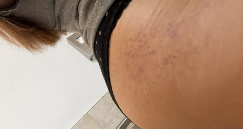 tinder hookup spanked me so much it left a mark …. i’d do let him do it again 😛🙈 by mislovelythang