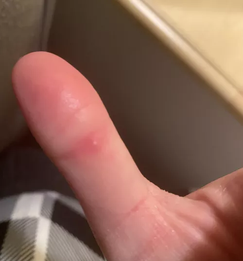 Tiny, painful, hard white bump right on the inside of the knuckle on my thumb. This is what I presume is a forbidden pop… has anyone else gotten something like this before? It hurts like mad to bend my thumb. It’s hard to see but the center of the bu by naynzaa