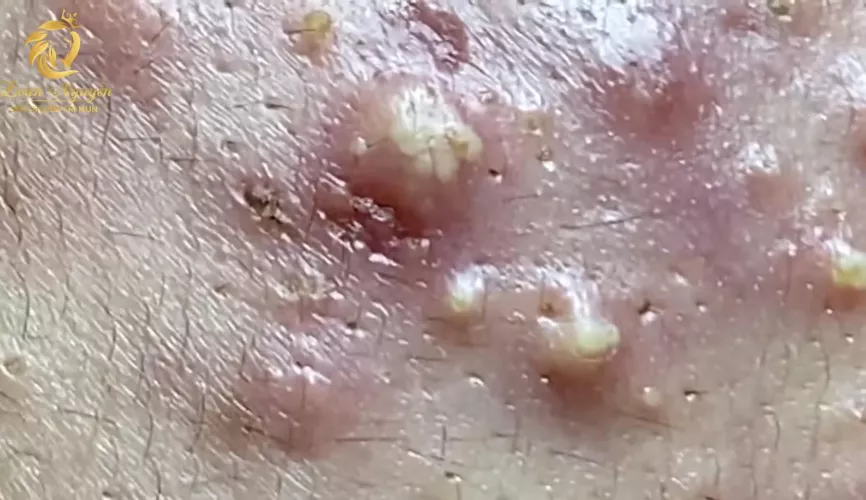 Today, I give thanks for this video of juicy white and yellow goodness being removed. The link is in the comments section because it’s a repost. There is glove wiping. by nightwingpianist