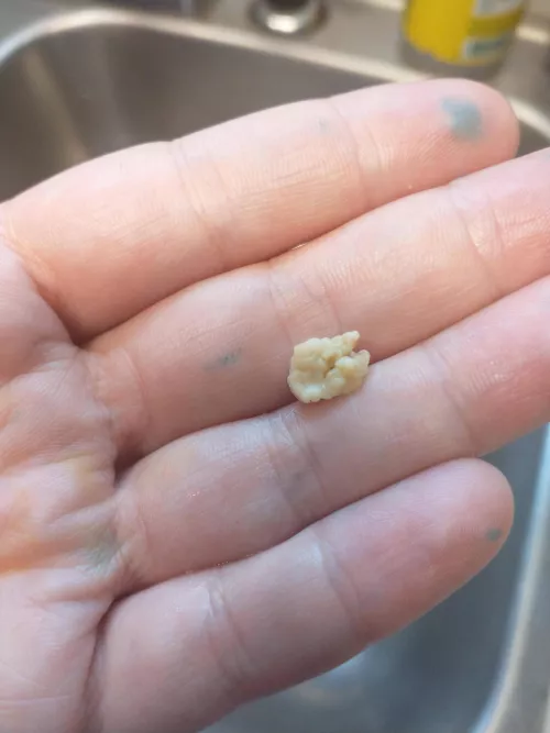 Tonsillectomy scheduled for next week! by _Soso_