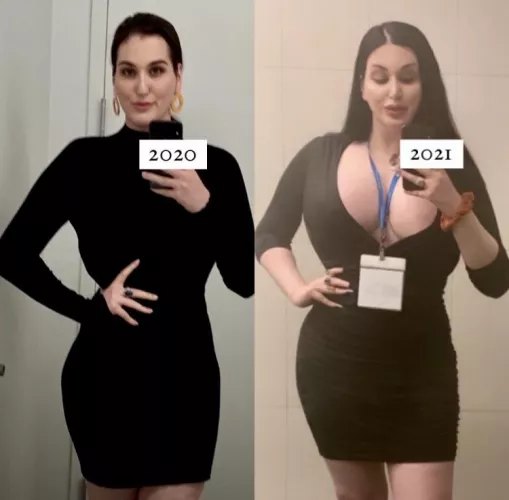 [TS] Bimbo Progression (850cc Implant,s FSF, Lip Filler) by latelegitimate