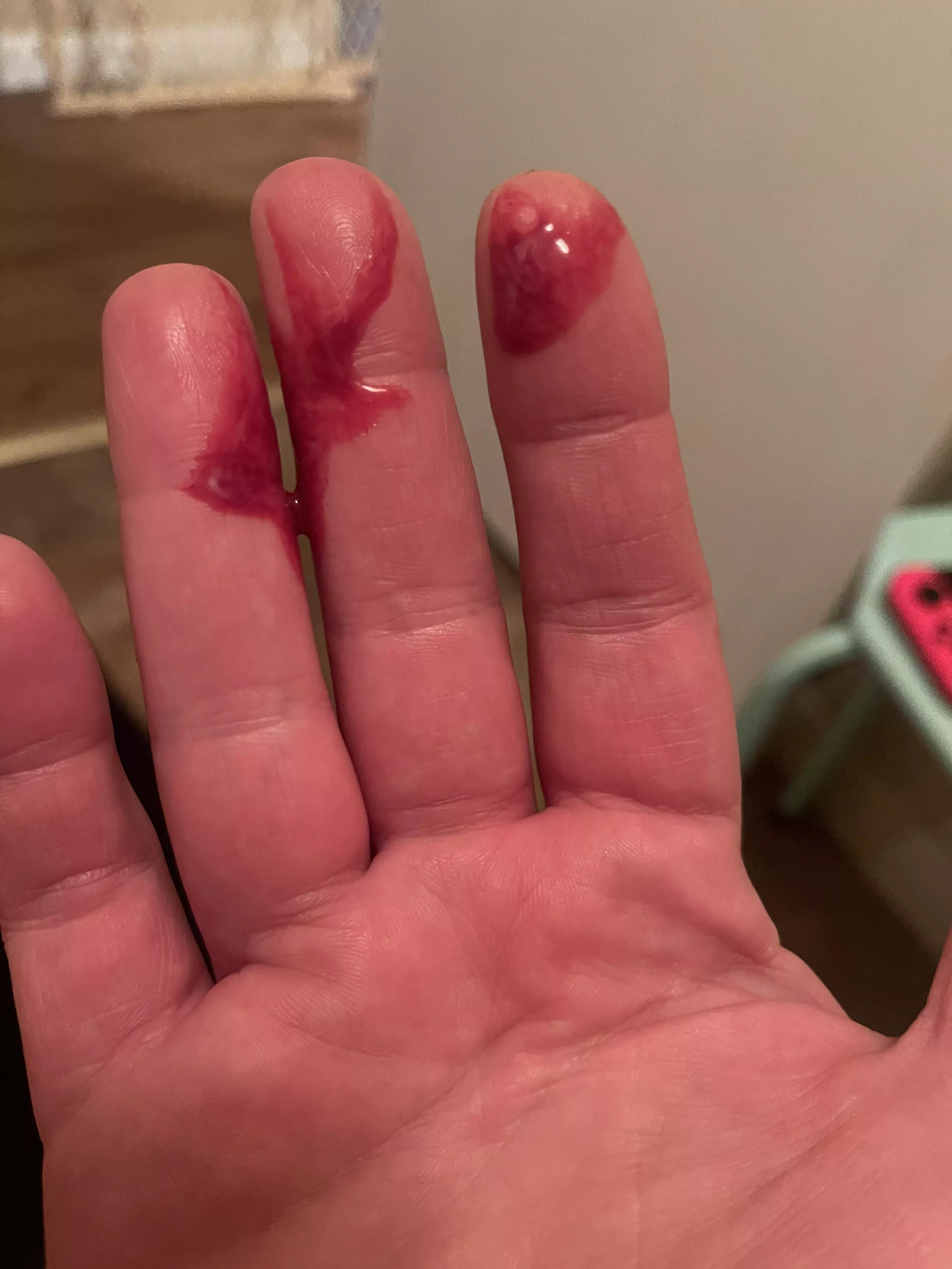 UGH that was painful. The aftermath of a armpit pop. It hurt for days, still feels full snd I can’t get anything else. I just couldn’t stand the pain anymore. posted by abrookehack