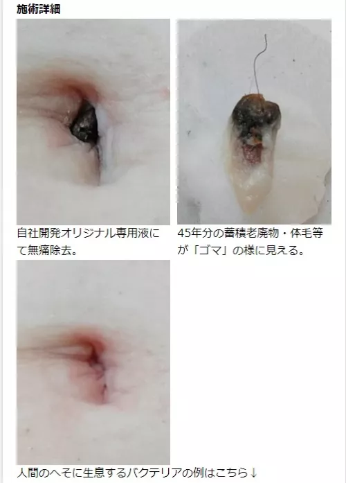 Umbolith Removal - Before and After Photos! by hizzy2000