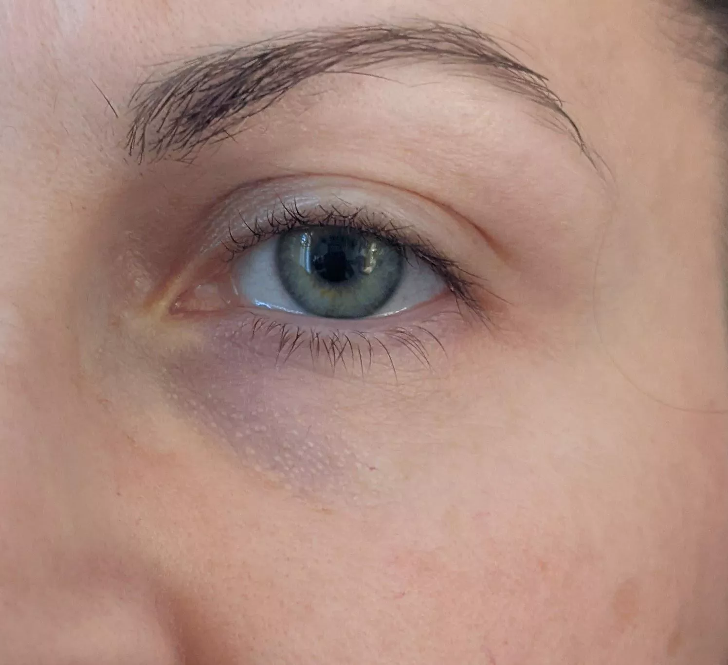 Under eye forbidden pops . Any ideas how to get rid of them safely? posted by Material-Speed-5972