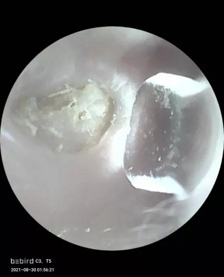 UPDATE on the infected hole in my ear and my hospital trip. (Old photo as placeholder) by Living-Ad-6751