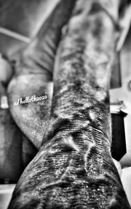 Veins always come out post bath by helloth2020