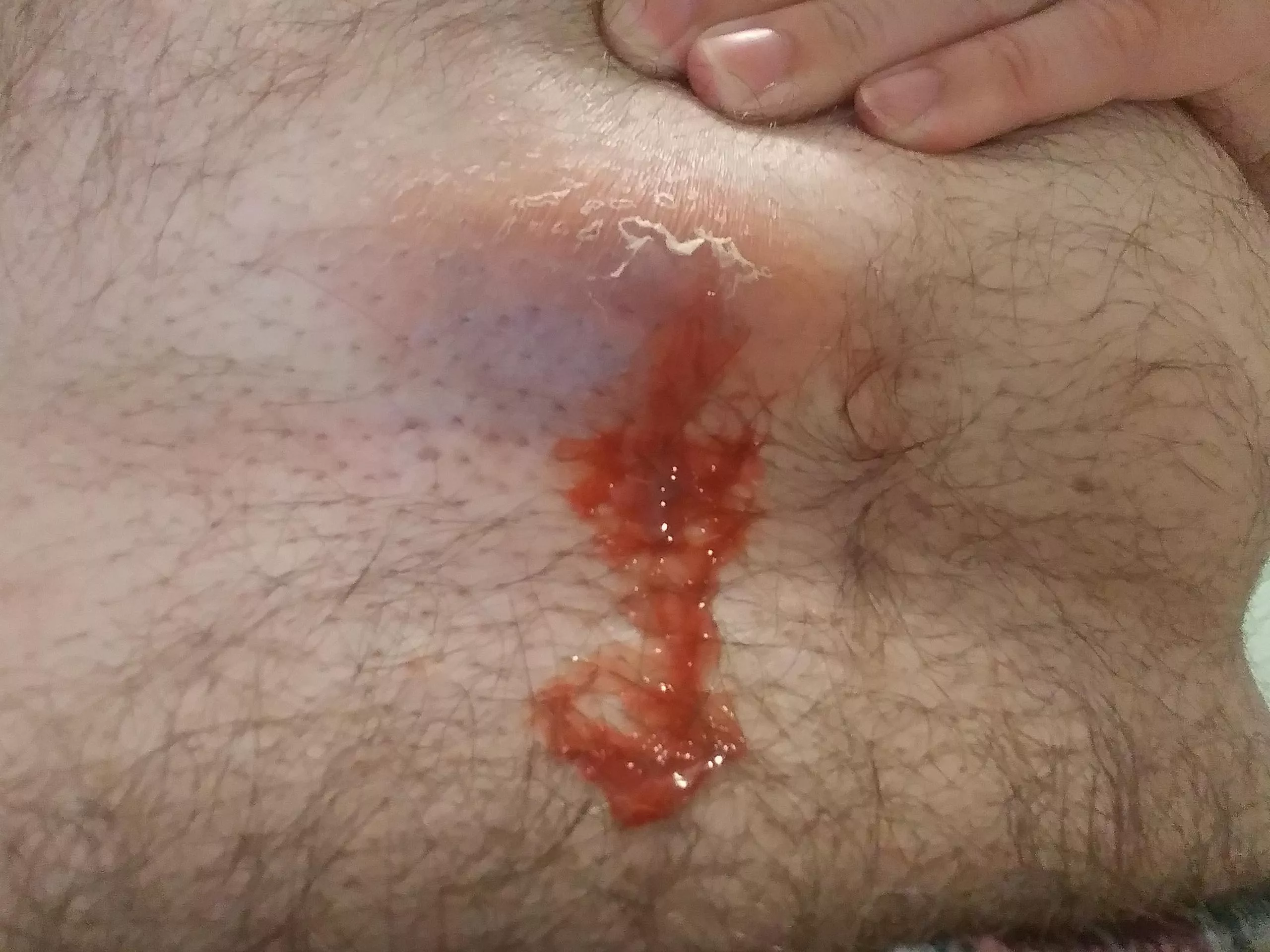 Week Old Abscess Starting to Drain - Presc Antibiotic posted by jabba-du-hutt