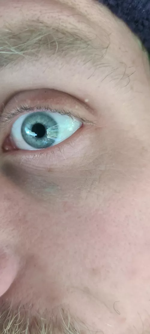 What are these things on my eyelids? They don't pop and aren't sore or anything. Had them for a year or so, maybe longer. by Willing_Still_9516