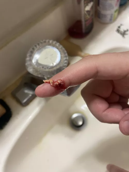 What came out of an Infected pimple/boil (no video unfortunately) by One-Trick-Tuna