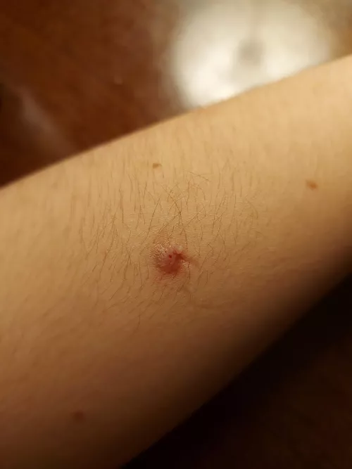 What is this on my arm? The skin around is rough, and it's the fifth time I've had to pop it. I have keratosis on my arms but have seen nothing like this before by Hitmoth