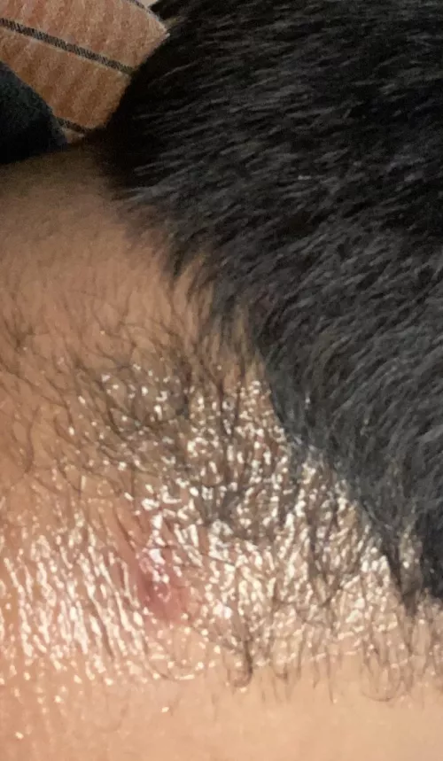 What kind of Cyst/Acne is this? by redditor69420___