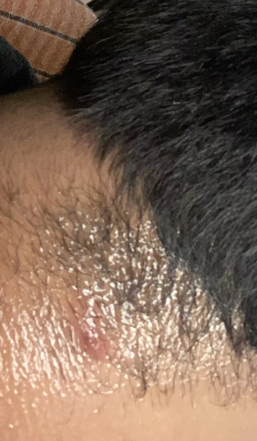 What kind of Cyst/Acne is this? posted by redditor69420___