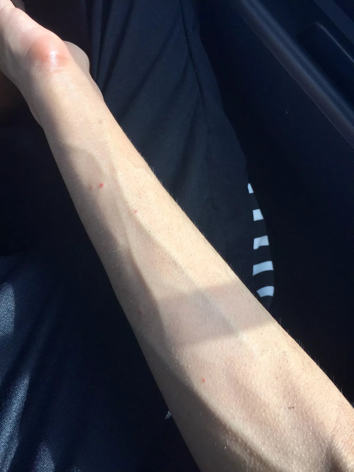 who loves forearms more: this sub or the mosquitoes that did this to me 🤕 posted by seaboy8