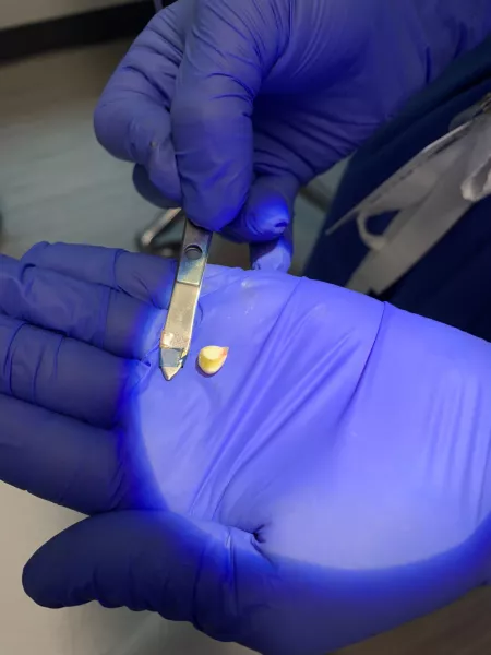 Wife's salivary gland stone by JohnTrapper