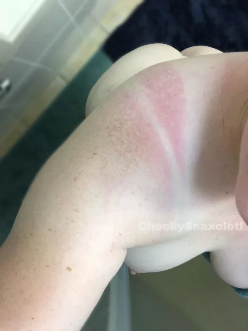 Wishing you all a year of better sunscreen appliance than my own by CheekySnaxolotl