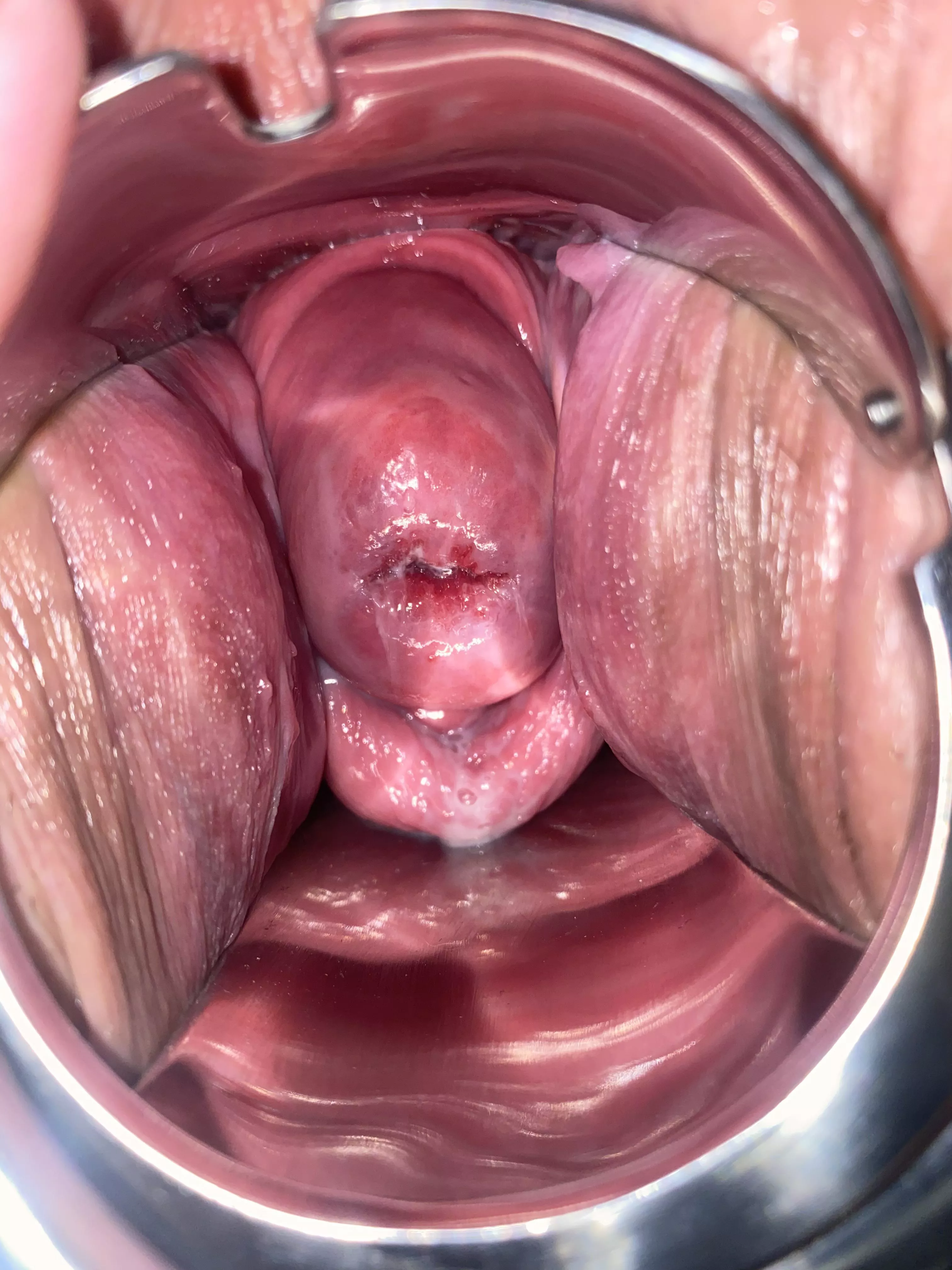 Would you say this speculum inserted nicely ?? posted by Dodgeguy19222