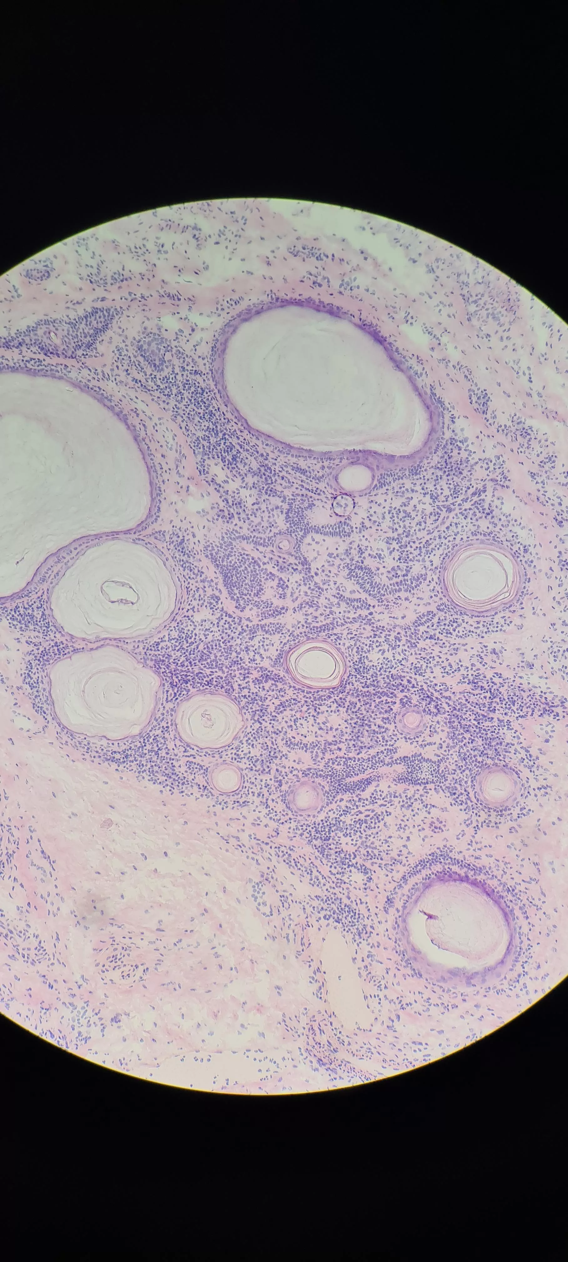 You guys seemed to like my previous histo images of cysts. Here is a particularly dense cystic structure in an eyelid. Thankfully cancer free. posted by Parmenion87
